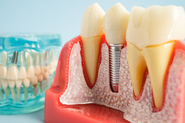 Best Periodontal (Gum) Disease Treatment  in USA